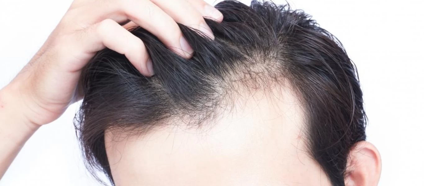 Τριχόπτωση λόγω άγχους: Με αυτούς τους τρόπους θα την αντιμετωπίσετε